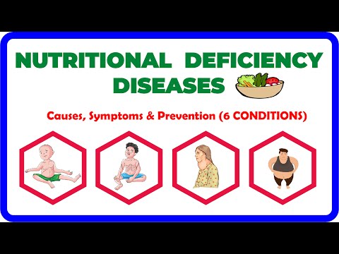 NUTRITIONAL DEFICIENCY Diseases: Causes, Symptoms, and Prevention