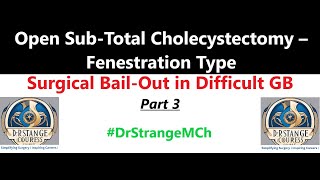 Open Sub-Total Chole (ORG, TEASER)– Fenestration type. [ Sub-Total Cholecystectomy Series Part 3/3].