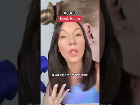 Have you dealt with a neck hump?