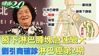 劉引商腋下淋巴腫塊急速變大 確診淋巴癌第2期 健康2.0
