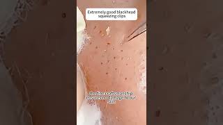 Essential pimple extractor tool for clean & healthy skin #blackhealthyskin