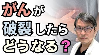 がんが破裂したらどうなる？肝細胞がんの自然破裂について解説