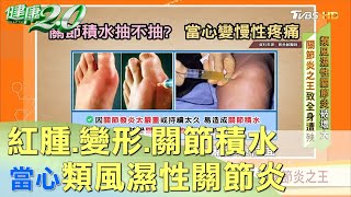 紅腫+變形？ 關節積水也可能是類風濕性關節炎！ 健康2.0