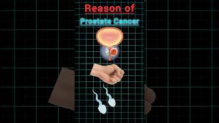 Reason of prostate cancer♋