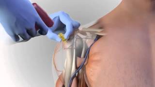 Arrow® EZ-IO® Proximal Humerus Site Animation