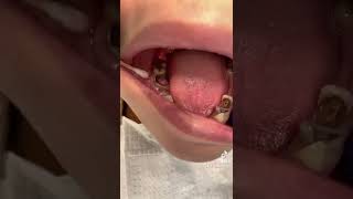 Pulp polyp , also known as chronic hyperplastic pulpit #tiktok #trending #fyp #video #viral #facts