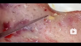 Stop Popping Pimples! 😬 Dermatologist Explains Why It’s Dangerous