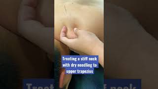 Releasing upper trapezius with dry needling to reduce neck stiffness #shorts #dryneedling #physio
