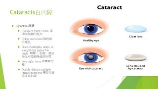 Ophthalmologist explains cataracts 眼科医生解释白内障