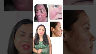 Skin brightening treatment pigmentation lightening steroid free face detan #skindoctor dermatologist