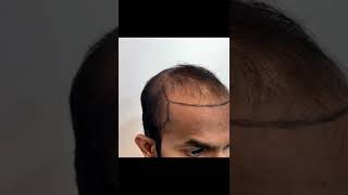Hair Transplant Results with 4000 grafts by Dr. Sanjay Sakhamuri  Sasha Luxe, Hyderabad