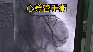 心導管手術