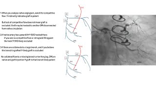 Grafts angiography tips