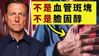 80%心臟病和中風的真正原因,抗血栓自然療法,柏格醫生 Dr Berg