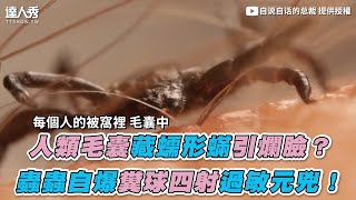 【蠕形蟎藏人類毛囊引爛臉？ 蟲蟲自爆糞球四射過敏元兇！】| @STBoss