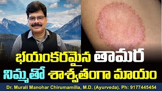 భయంకరమైన తామర నిమ్మతో శాశ్వతంగా మాయం! Remedy for Ringworm. #Shorts.