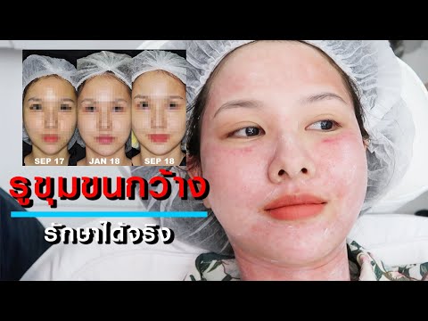 รักษารูขุมขนกว้างด้วย PICOSECOND  LASER| erk-erk