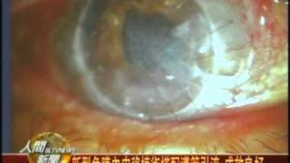20110311頑固性青光眼患者 角膜內皮移植重獲視力