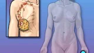 PreOp® Patient Education Mastectomy Modified Radical Surgery