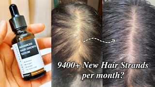 Bare Anatomy Advanced Hair Growth Serum 3 month Result + Review + Demo