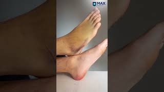 Winter Tips to Manage Neuropathy Symptoms Effectively