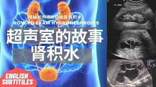 肾积水：肾积水是什么/什么人容易得肾积水/肾积水的症状和类型/B超是如何检查肾积水的/预防和治疗【Ultrasound Room】Hydronephrosis