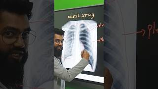 Pneumothorax #xray #ct #mri #radiology #medical #viral #anatomy #pathology #doctor #xrayroom #neet