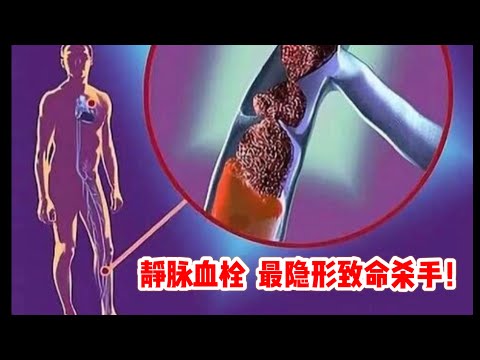 静脉血栓， 最隐形致命杀手！