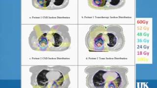 SBRT Treatment Plans vs Tomotherapy