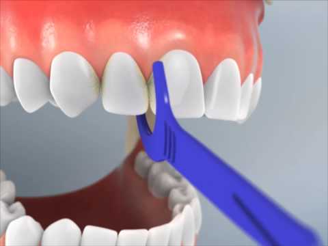Maxilla Flossing with a Hand Tool