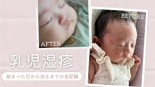 【酷い乳児湿疹】始まった日から治るまでの全記録✨保湿剤/お薬💊