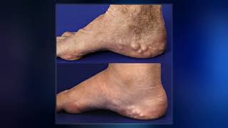 Ehlers–Danlos Syndromes