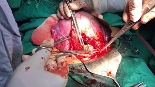 Cesarean delivery / C-section : Surgical technique - HD Video