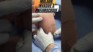 Pneumocoque Infection SPREADS Fast!