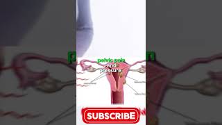 Benefits of Uterine Fibroid Embolization #shorts #usa #radiology  #intervention #uterinefibroids