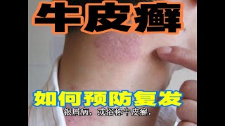 牛皮癣，银屑病如何预防复发？免疫抑制剂欣比克本维莫德,本维莫德,青黛胶囊
