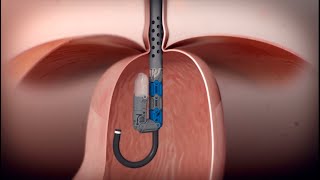 Incisionless Reflux Surgery - EsophyX Transoral Incisionless Fundoplication (TIF Procedure)