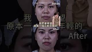 割眼袋後眼下皮膚會鬆弛？眼下緊緻怎麼做？#陳耕 #割眼袋 #整形手術 #眼下鬆弛 #皮膚鬆弛 #淚溝