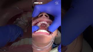 Jaw Expander | Jaw Expansion Braces | Before and After - #dentalbraces #braces #dental #jawline
