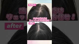 女性の薄毛治療症例です！　#女性の薄毛
