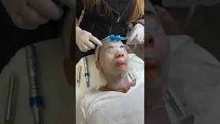 Glowing Skin: The Power of Bio-Cellulose Anti-Acne Mask and Cryo Globes for Flawless Complexion!"