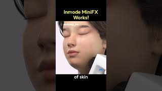 Inmode MiniFX Works!