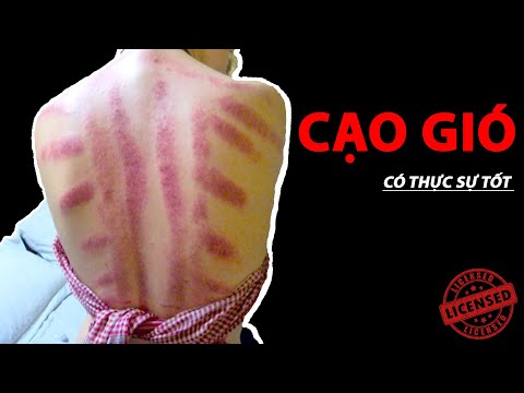 CẠO GIÓ  để chữa bệnh, có thực sự tốt  ???| Kiến Thức Hữu ích