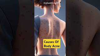Causes Of Body Acne! #shorts #acneawareness #acne #shortsfeed #animation #glambites2.0 #trending