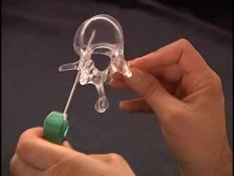 Video 2. Transpedicular lumbar