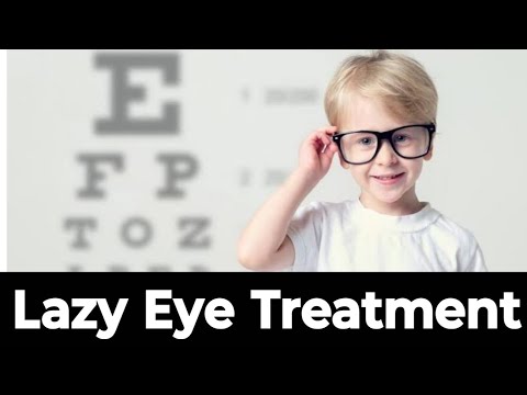 Amblyopia - lazy eye Treatment। 6/36 previous  vision 6/6 after vision Therapy  without patching।
