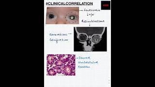 #Shorts|ClinicalCorrelation| NEET/NEXTPG/FMGE/MBBS | Retinoblastoma