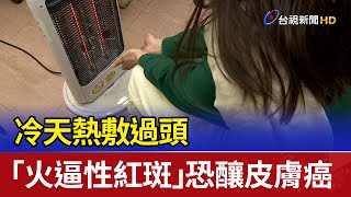 冷天熱敷過頭「火逼性紅斑」 恐釀皮膚癌