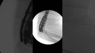 Distal Humerus Fracture #ortho #trauma #science #education #humerus #fracture