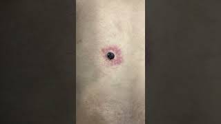 Skin Tag Removal by Laser 💥 | Say Goodbye to Annoying Skin Tags | Skinaa Clinic #viral